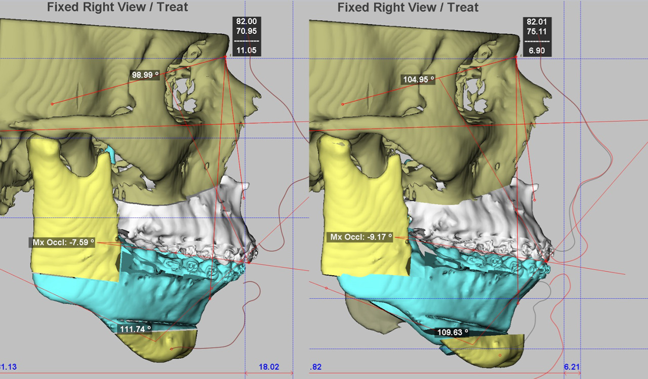3D-моделирование в челюстно-лицевой хирургии открывает новые возможности и врачам, и пациентам