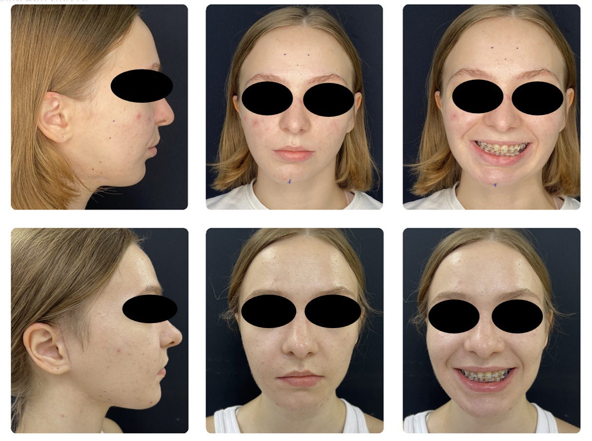 3D-моделирование в челюстно-лицевой хирургии открывает новые возможности и врачам, и пациентам