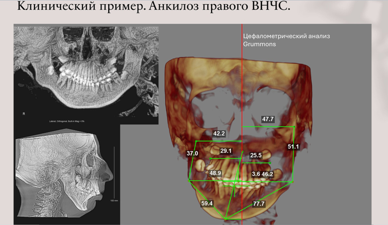 3D-моделирование в челюстно-лицевой хирургии открывает новые возможности и врачам, и пациентам