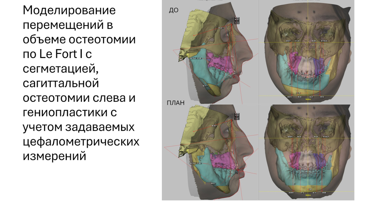3D-моделирование в челюстно-лицевой хирургии открывает новые возможности и врачам, и пациентам