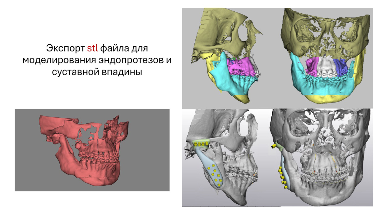 3D-моделирование в челюстно-лицевой хирургии открывает новые возможности и врачам, и пациентам