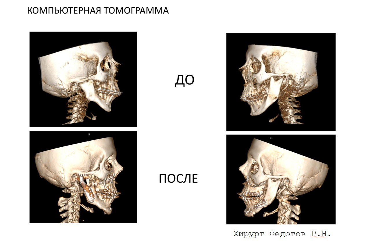 3D-моделирование в челюстно-лицевой хирургии открывает новые возможности и врачам, и пациентам