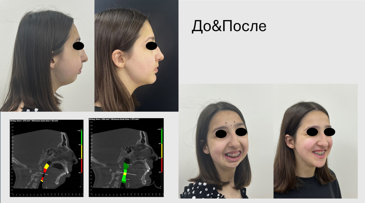 3D-моделирование в челюстно-лицевой хирургии открывает новые возможности и врачам, и пациентам