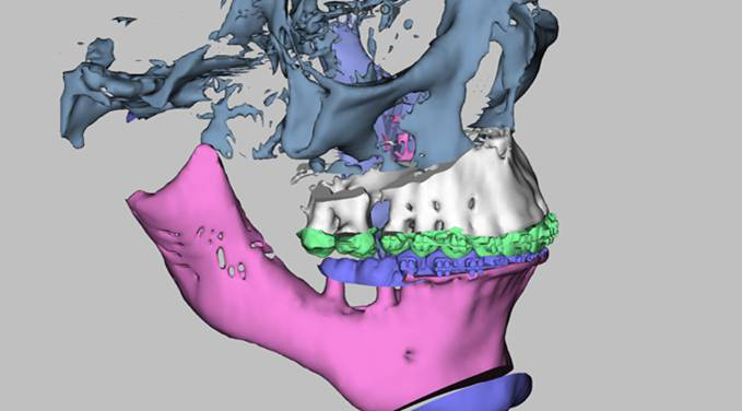3D-моделирование в челюстно-лицевой хирургии открывает новые возможности и врачам, и пациентам