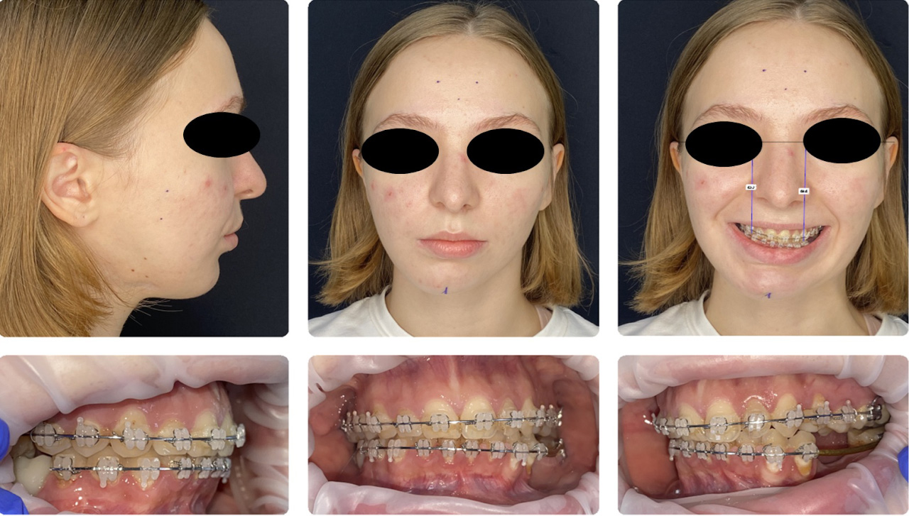 3D-моделирование в челюстно-лицевой хирургии открывает новые возможности и врачам, и пациентам