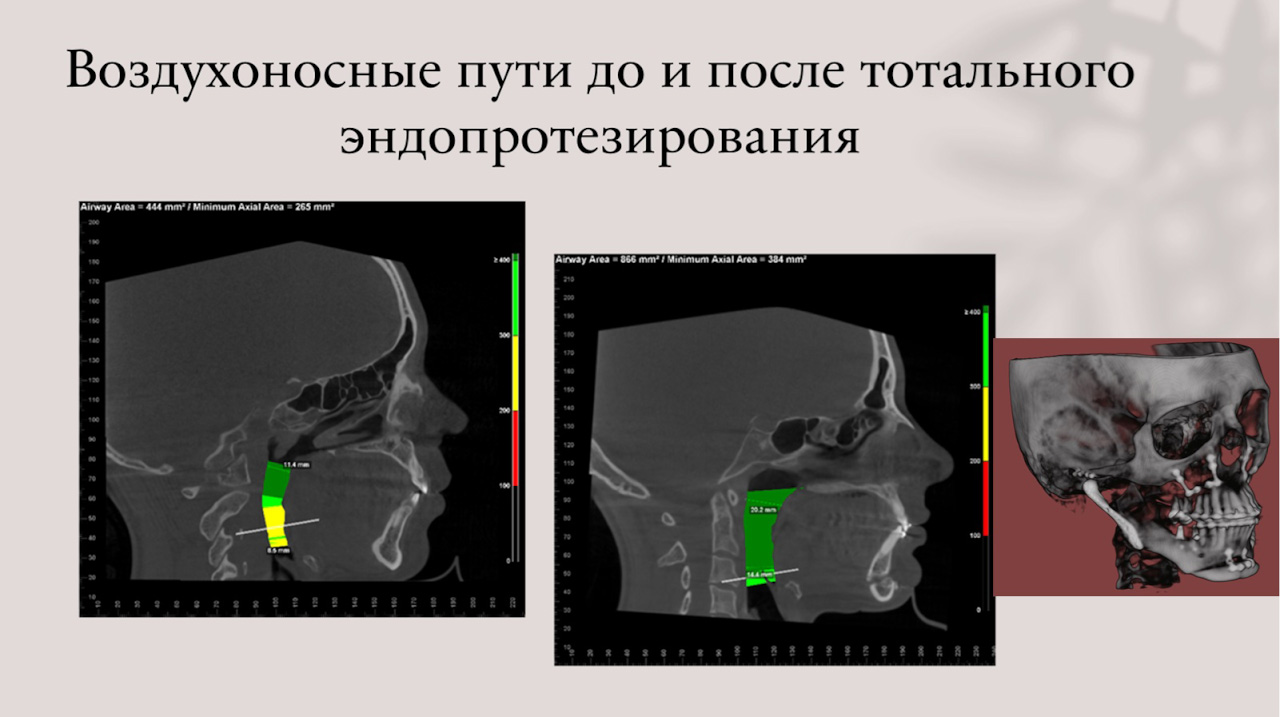3D-моделирование в челюстно-лицевой хирургии открывает новые возможности и врачам, и пациентам